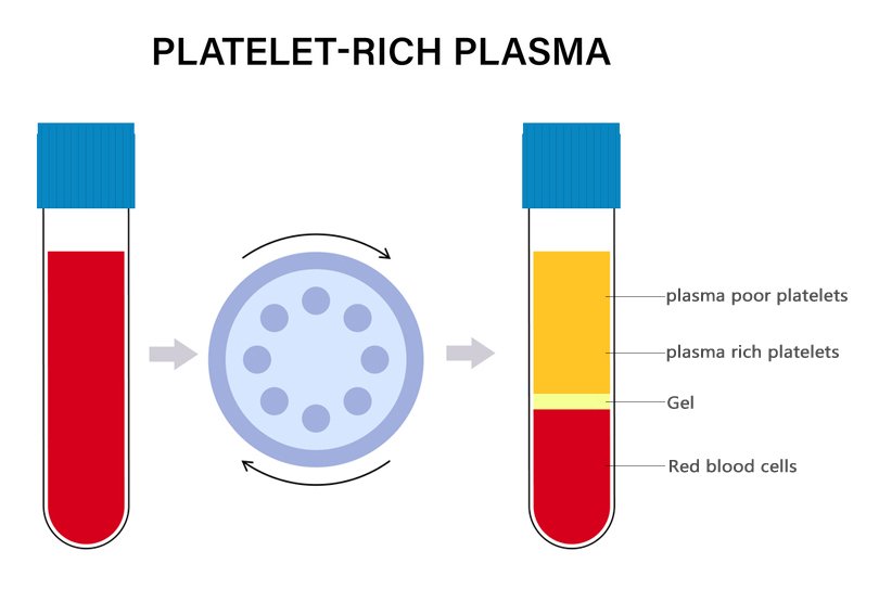 1760163965711238.jpg prp centrifugal.jpg